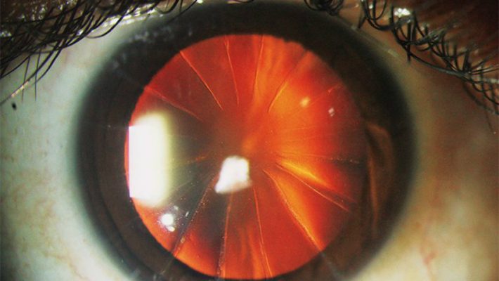As cirurgias oculares que deixavam a córnea fatiada como uma pizza