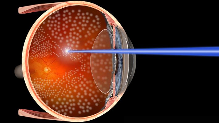 Fotocoagulação: laser para tratar os olhos